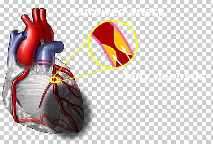 disease clipart coronary artery disease