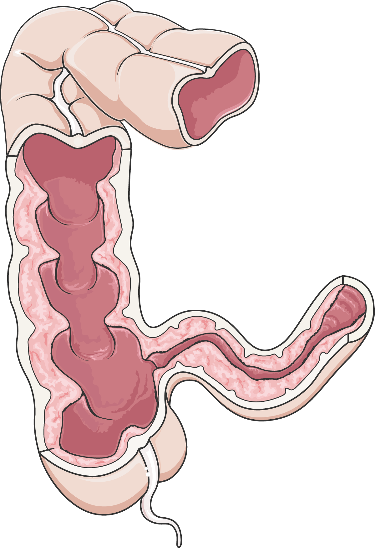 disease clipart crohn's disease