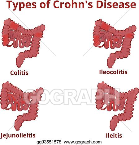 Disease clipart crohn's disease. Vector stock crohn s