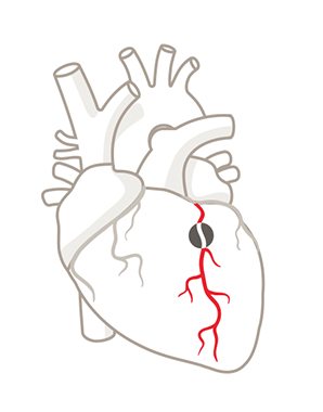 disease clipart heart attack