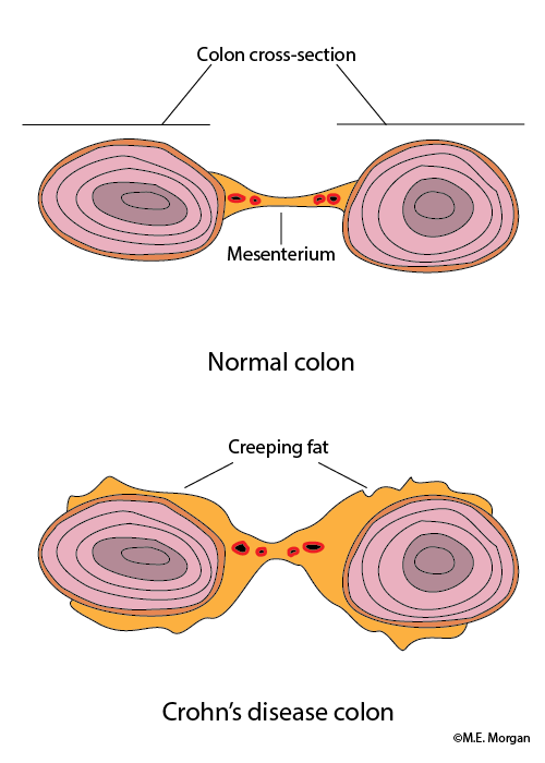 Disease clipart ulcerative colitis. The function of creeping