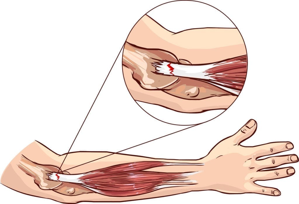 Elbow clipart muscle. Tennis causes and treatment