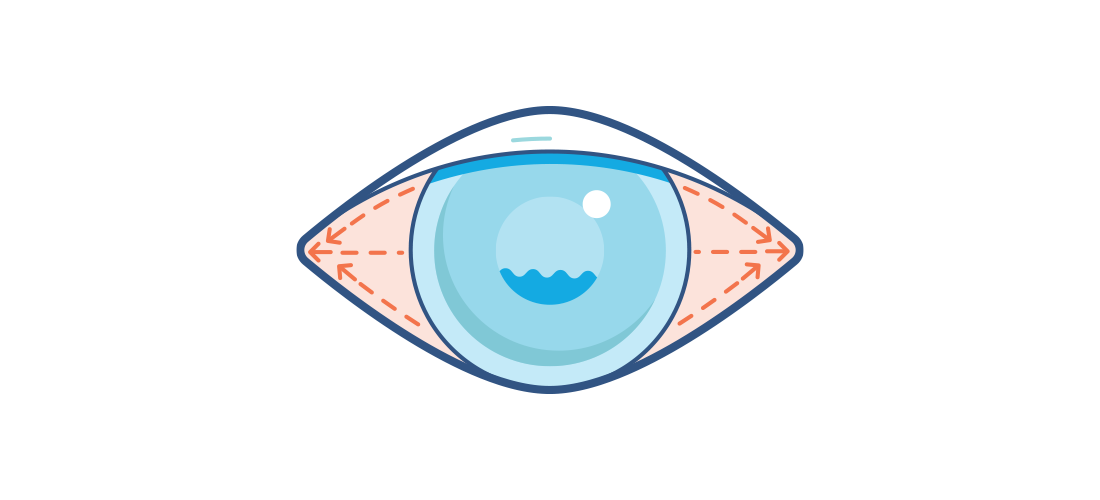 What is glaucoma acuvue. Vision clipart eye health