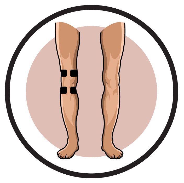 Electrode pad placement by. Hurt clipart knee surgery