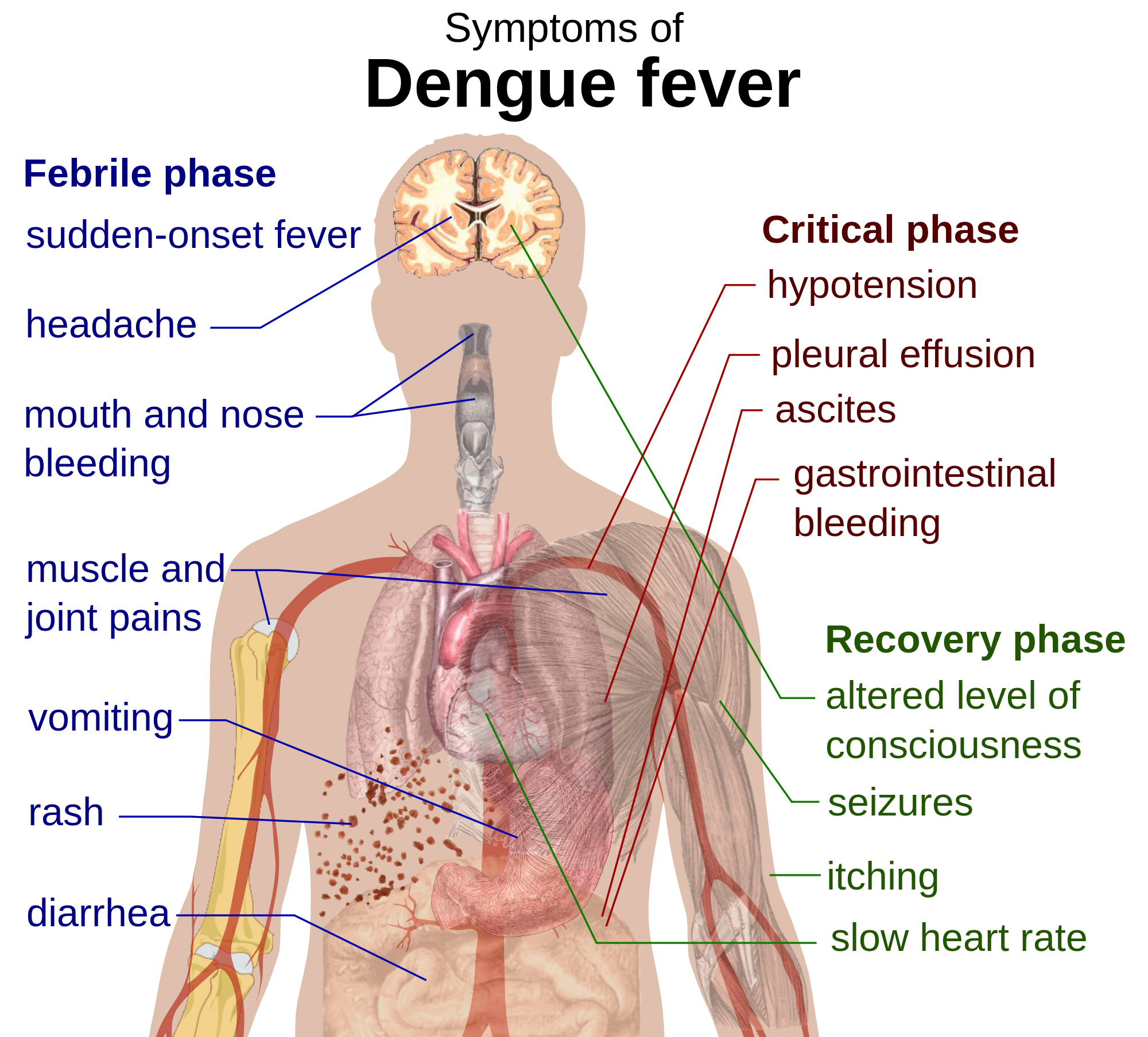 fever clipart cholera symptom