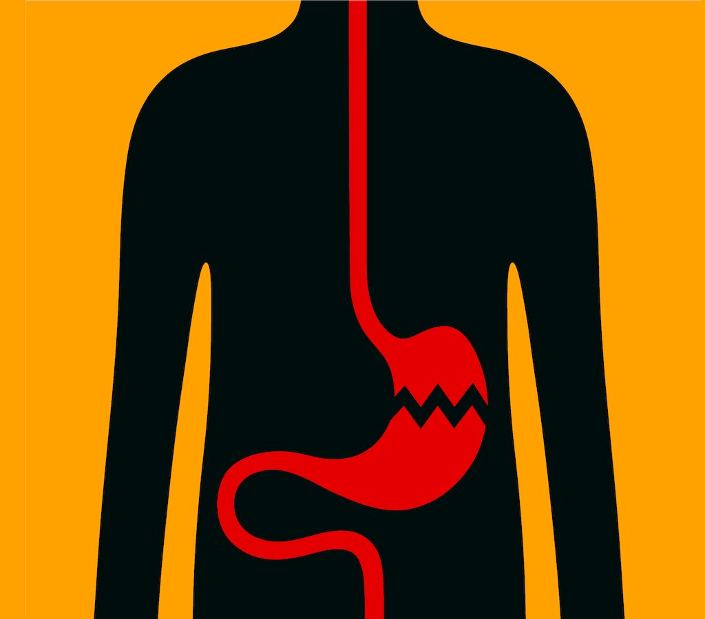 fever clipart gastric