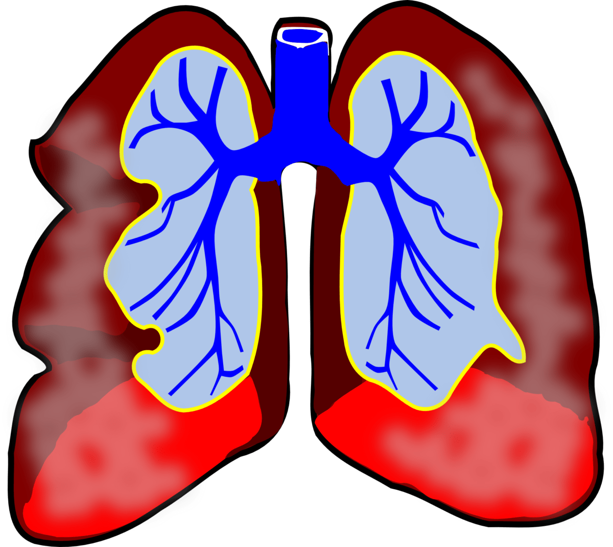 fever clipart low immunity