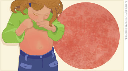 fever clipart scarlet fever