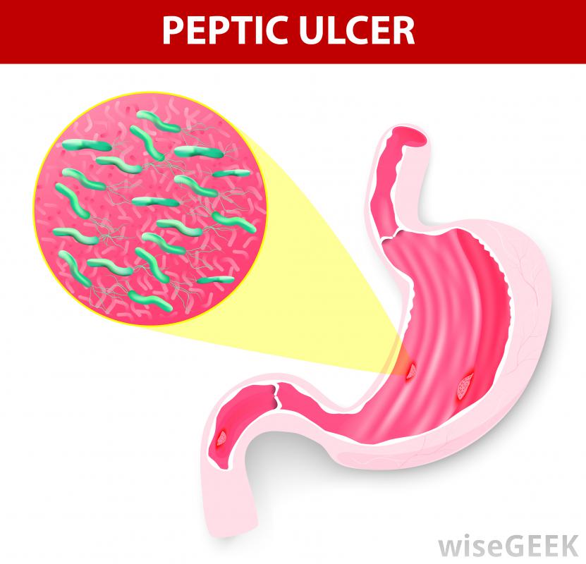 fever clipart stomach ulcer