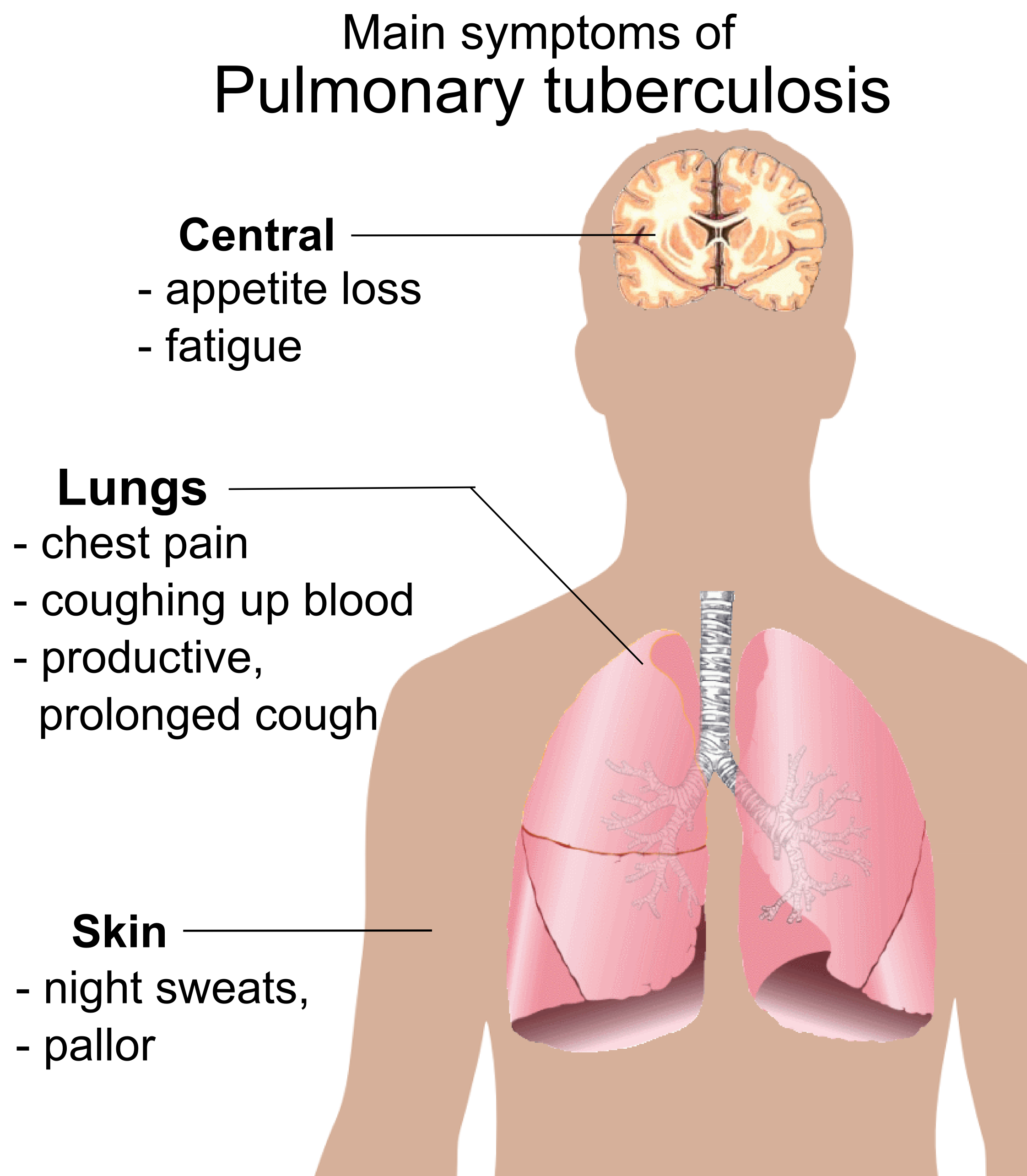 lungs clipart tb patient