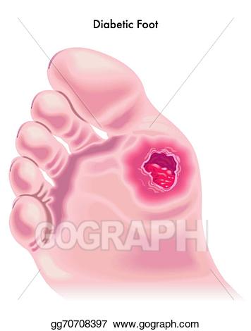 foot clipart diabetic foot