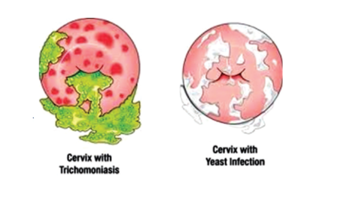 germs clipart yeast infection