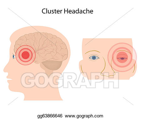 headache clipart eye pain