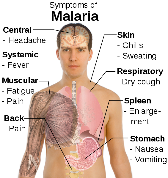 headache clipart malaria symptom