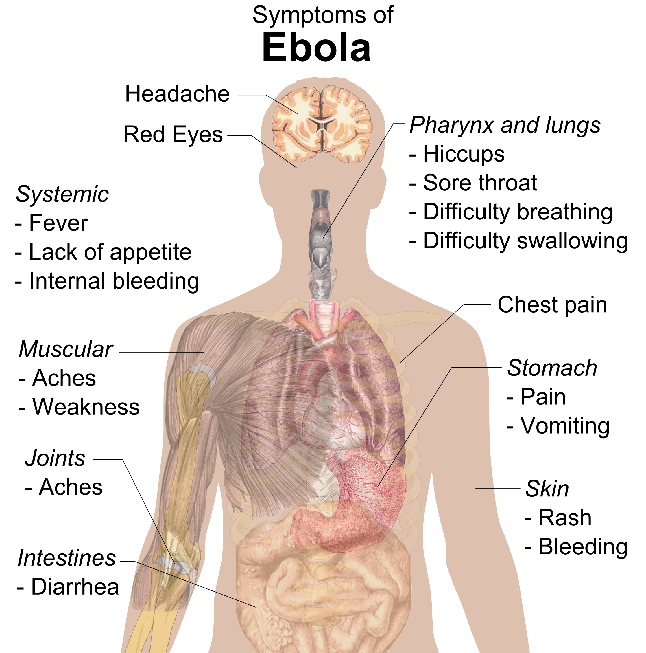Ebola virus the biology. Headache clipart malaria symptom