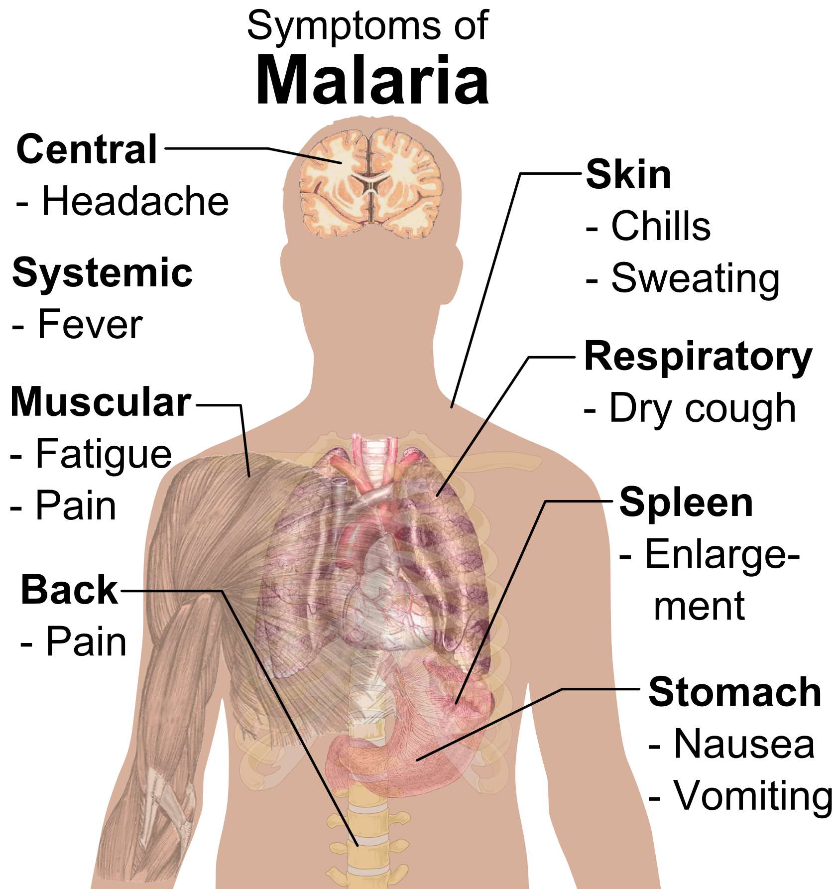 Headache clipart malaria symptom. By rafia mez infographic