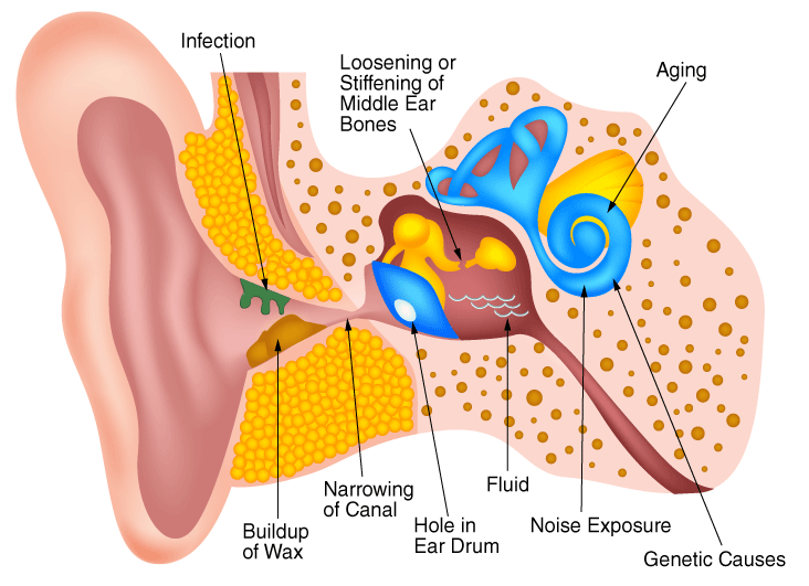 hearing clipart hearing loss