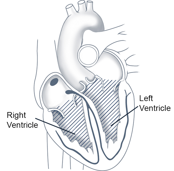 Ventricular cleveland clinic . Heartbeat clipart tachycardia