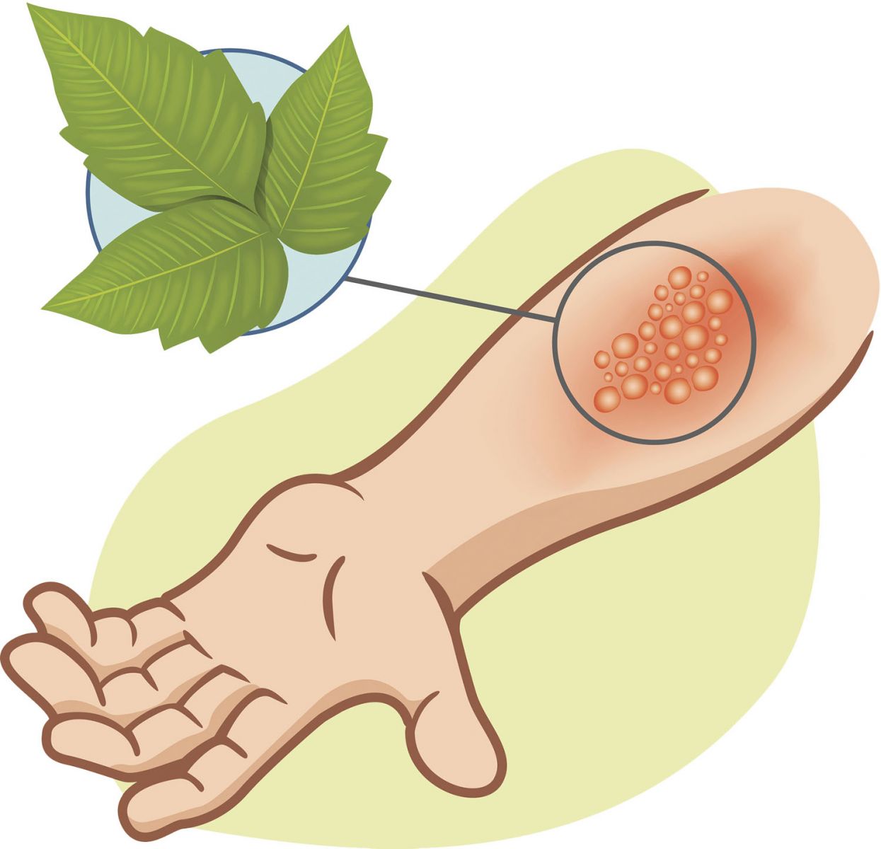 Skin clipart skin irritation. Common summer rashes harvard