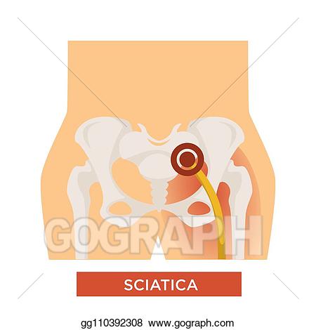 Injury clipart bone pain. Vector sciatica disease sciatic
