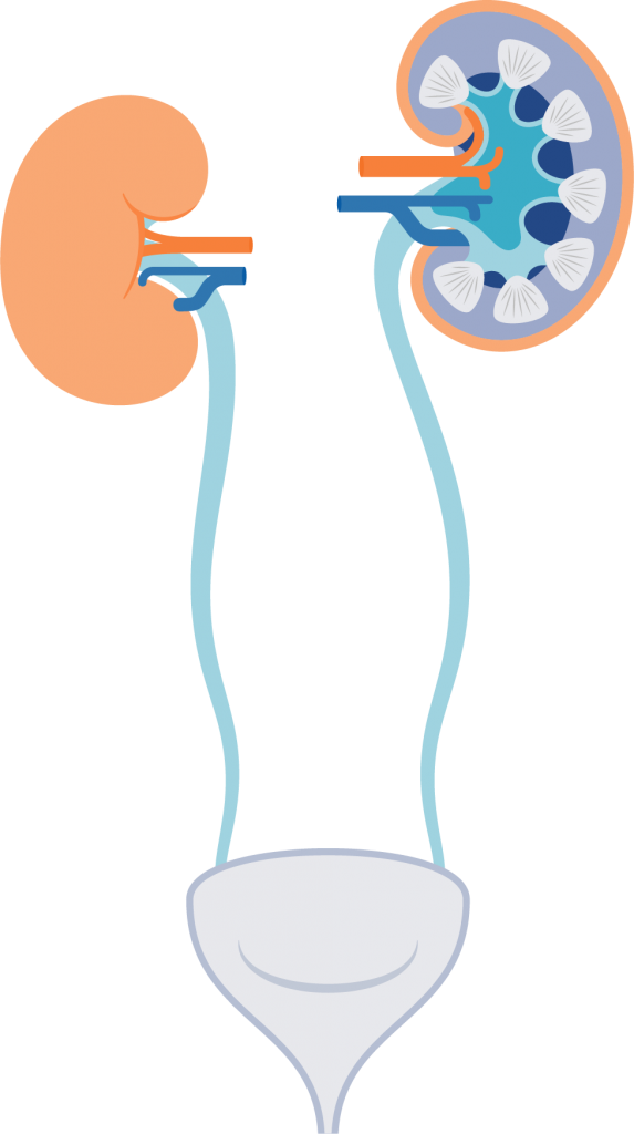 kidney clipart acute kidney injury