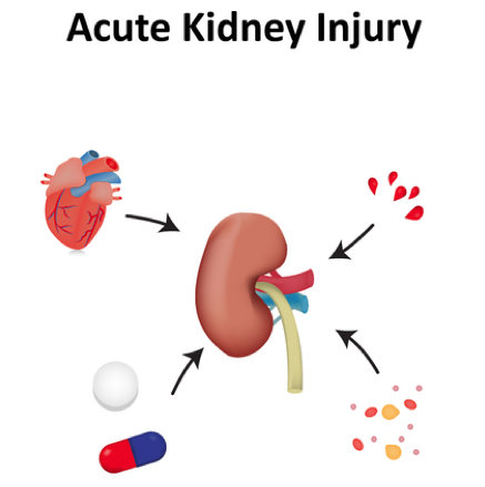 kidney clipart acute kidney injury