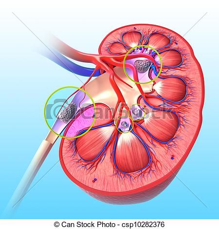 kidney clipart causes