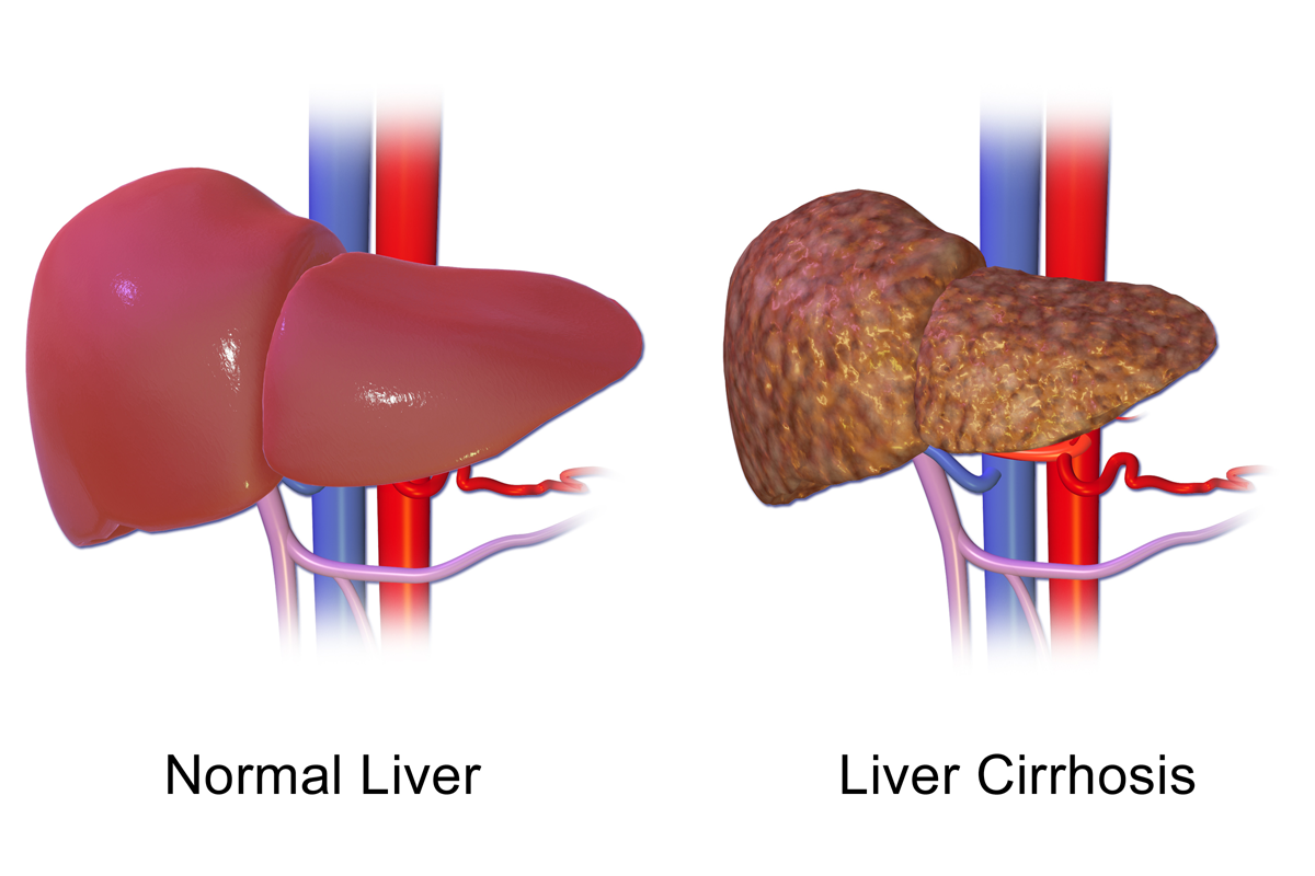 kidney clipart cirrhosis