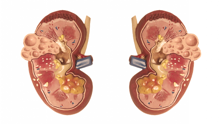kidney clipart kidney cancer