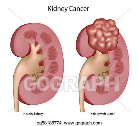 kidney clipart kidney cancer