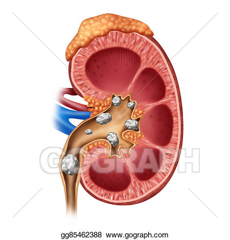 Stones stock illustration gg. Kidney clipart kidney stone