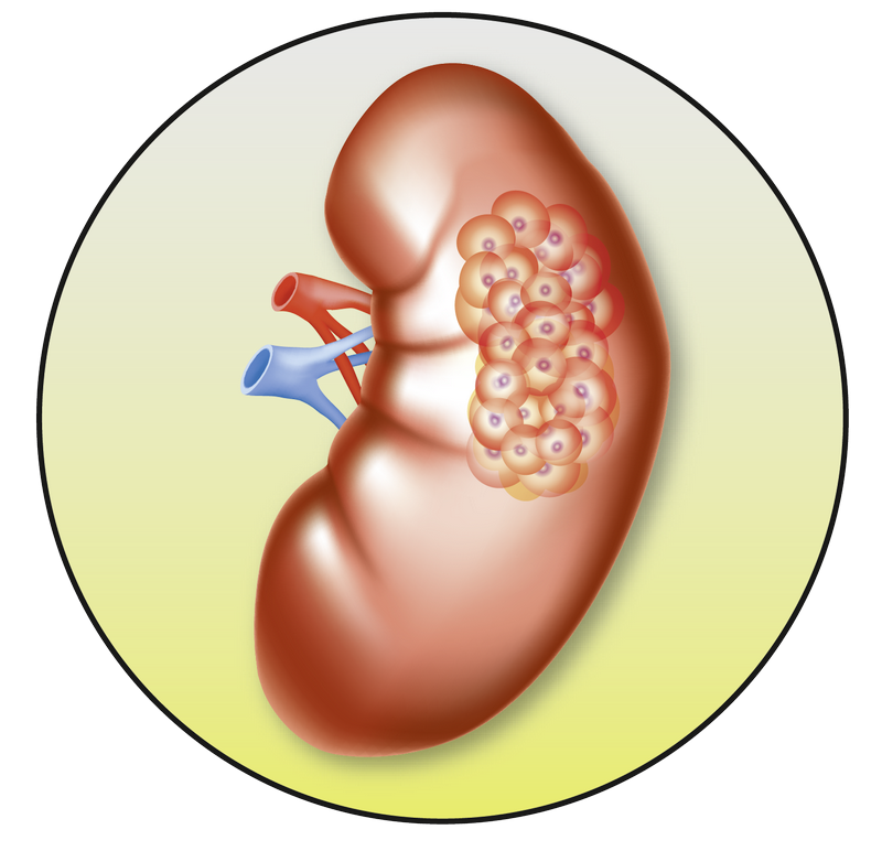 Understanding therapy options in. Kidney clipart pair