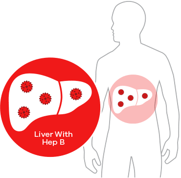 liver clipart hepatitis b