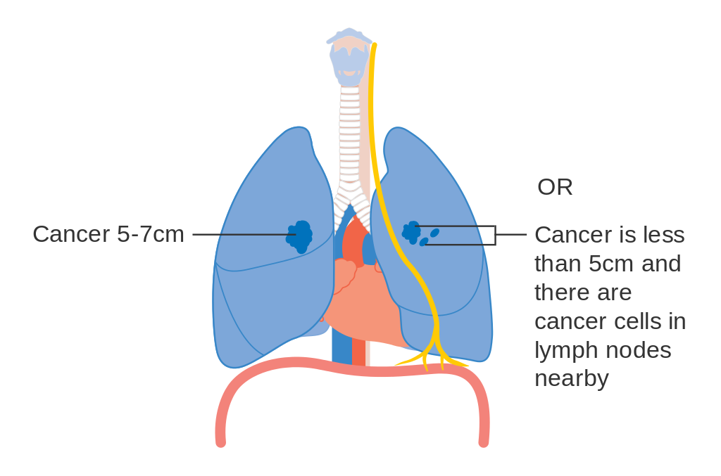 One clipart lung. Non small cell cancer