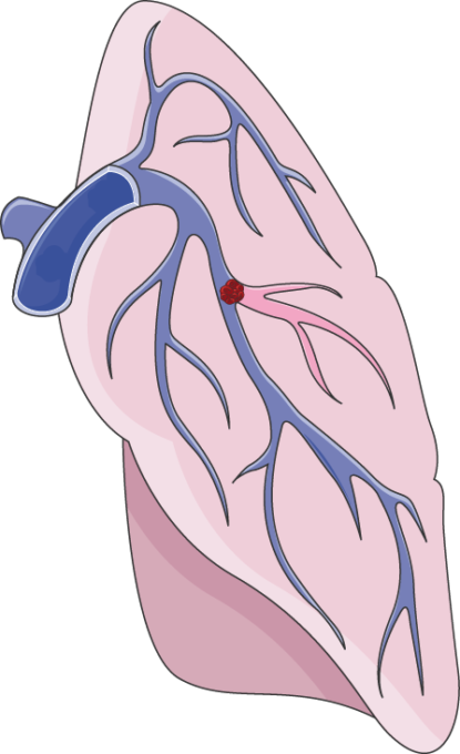 Servier medical art free. Lungs clipart pulmonary embolism
