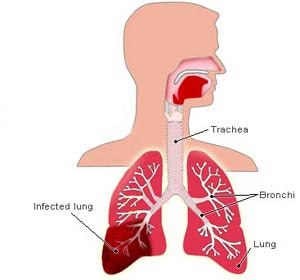 Free treatment cliparts download. Lungs clipart respiratory problem