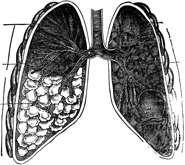 Lung with tuberculosis etc. Lungs clipart tb patient