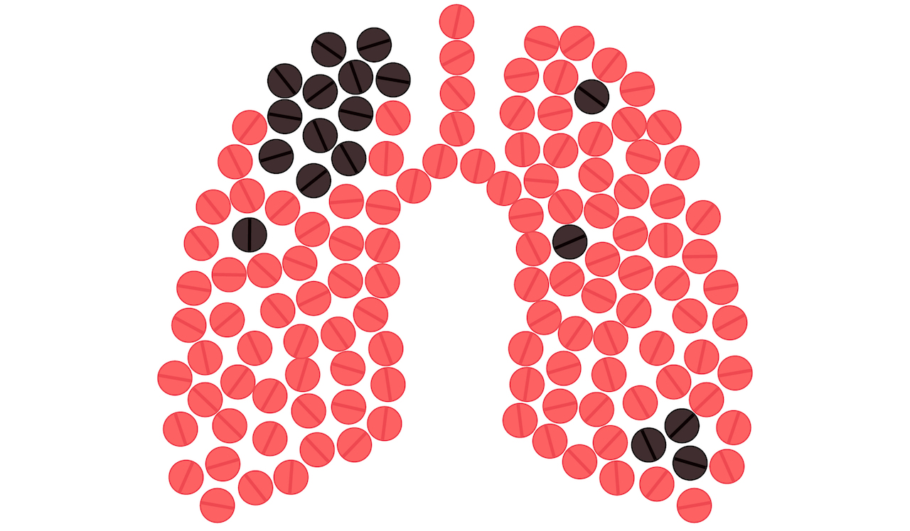 Lungs clipart tb patient. The hello doctor medical