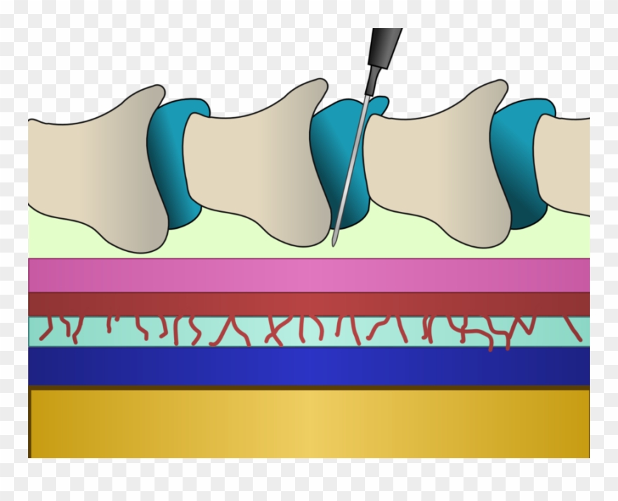 needle clipart epidural