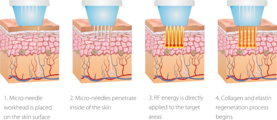 needle clipart steroid needle