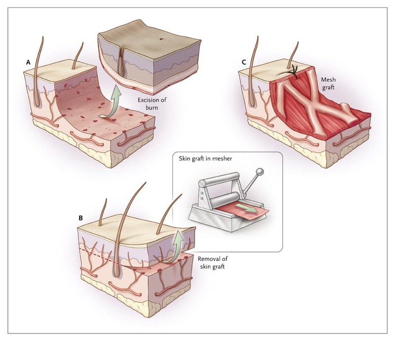 Excision and grafting of. Skin clipart thermal burn