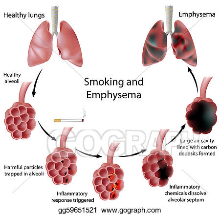 smoking clipart emphysema