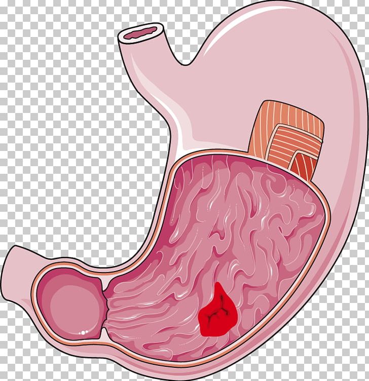 Peptic ulcer disease digestion. Stomach clipart stomach intestine