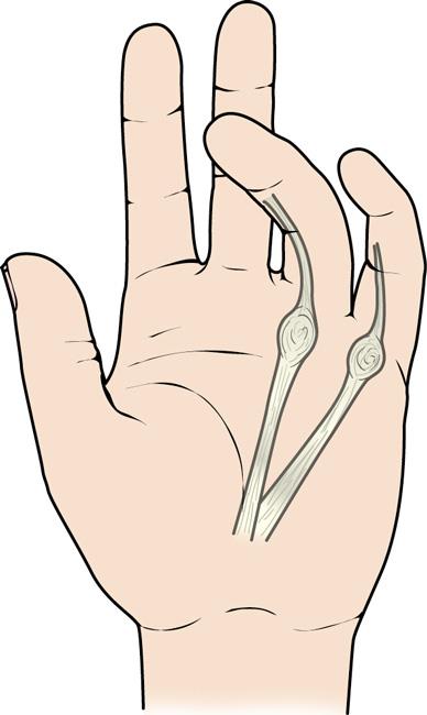 Dupuytren s disease contracture. Thumb clipart hand pain