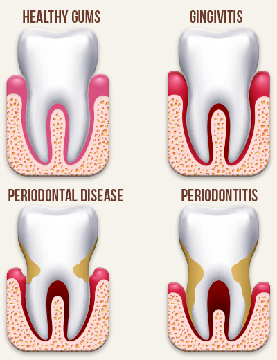 tooth clipart gingivitis