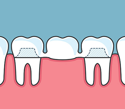 Tooth clipart thirty. Dental crowns and bridges