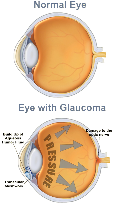Edwards walker opticians glaucomaimage. Vision clipart eye health