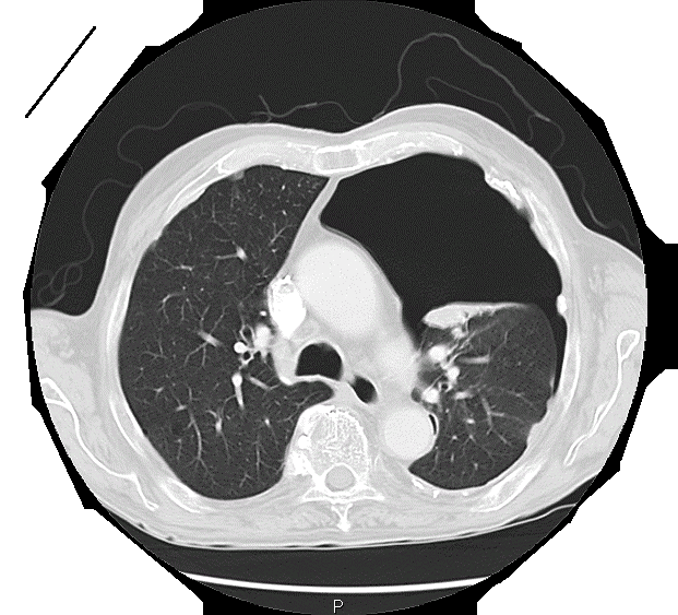 Html view of the. Xray clipart thorax