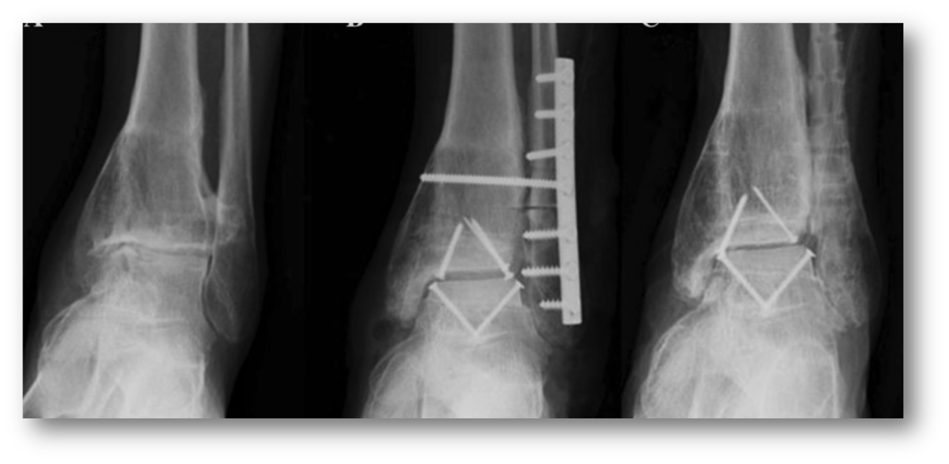 Cartilage repair www lowerextremity. Xray clipart xray broken bone