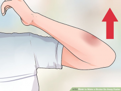 3 Simple Ways to Make a Bruise Go Away Faster - wikiHow